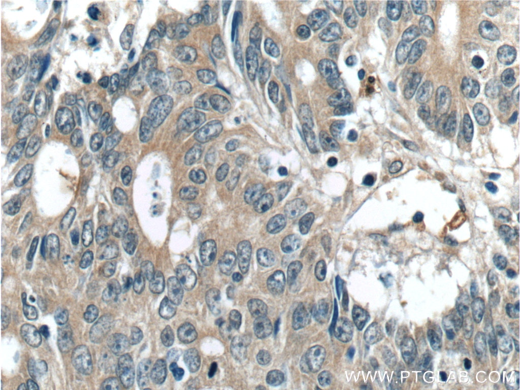 Immunohistochemistry (IHC) staining of human colon cancer tissue using FAM3B Polyclonal antibody (14043-1-AP)