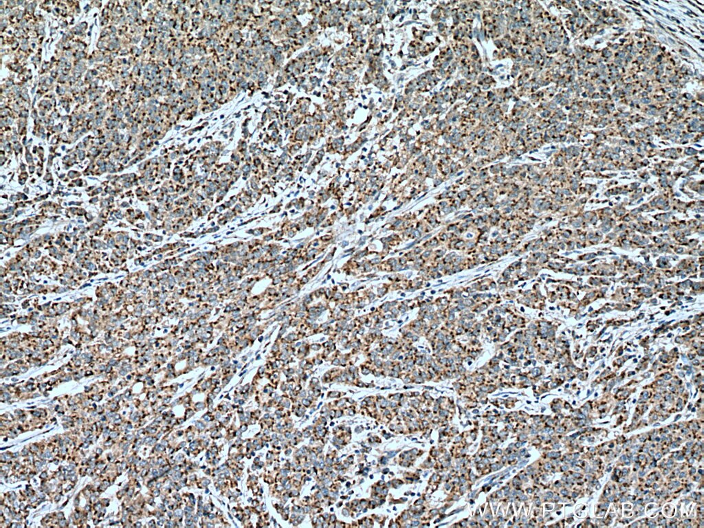 Immunohistochemistry (IHC) staining of human stomach cancer tissue using FAM3C Polyclonal antibody (14247-1-AP)