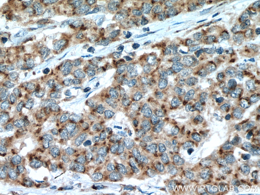 Immunohistochemistry (IHC) staining of human stomach cancer tissue using FAM3C Polyclonal antibody (14247-1-AP)