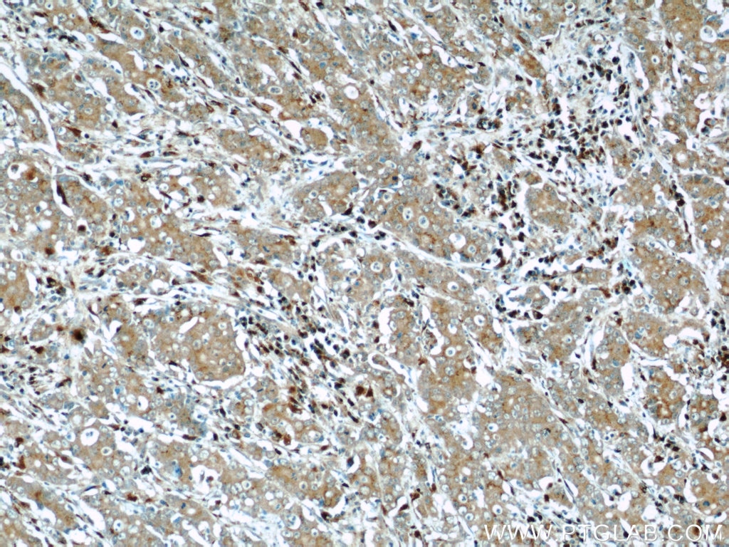 Immunohistochemistry (IHC) staining of human stomach cancer tissue using FAM3C Polyclonal antibody (14247-1-AP)