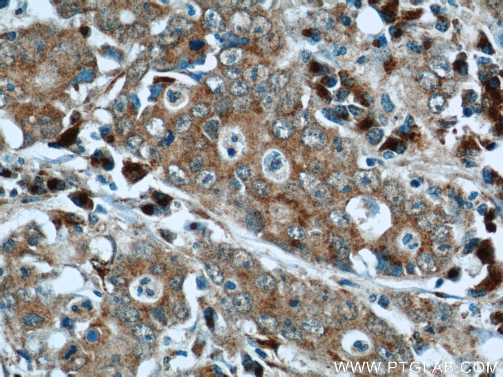 Immunohistochemistry (IHC) staining of human stomach cancer tissue using FAM3C Polyclonal antibody (14247-1-AP)