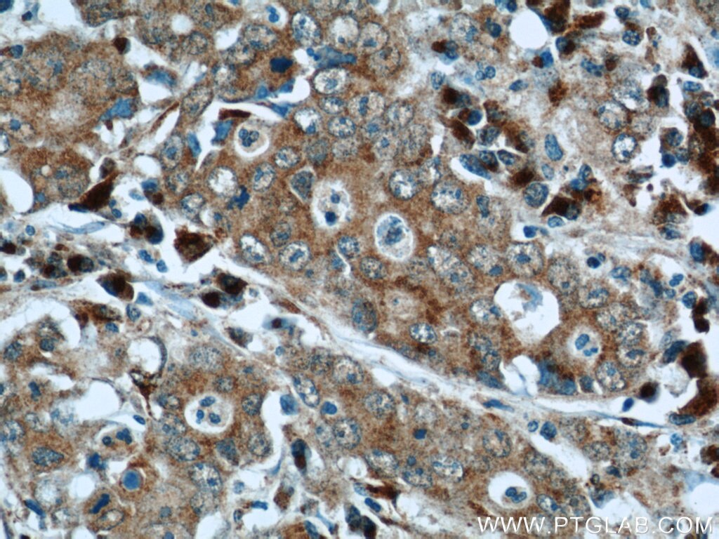 IHC staining of human stomach cancer using 14247-1-AP