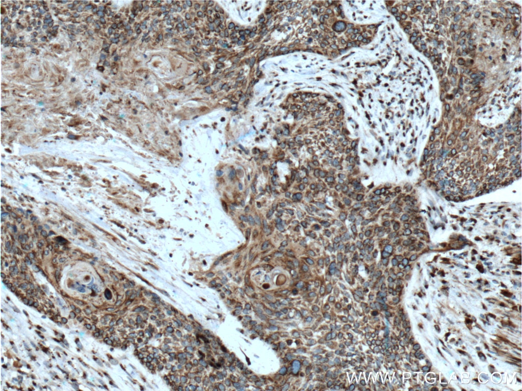 Immunohistochemistry (IHC) staining of human oesophagus cancer tissue using FAM3C Monoclonal antibody (60282-1-Ig)