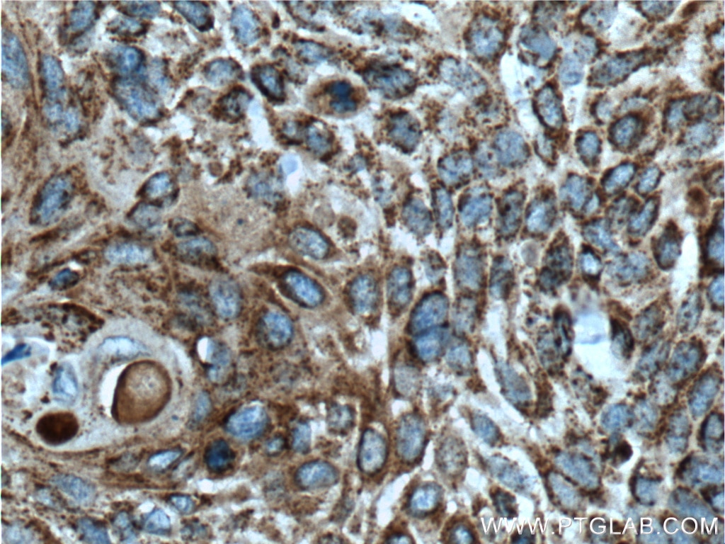 Immunohistochemistry (IHC) staining of human oesophagus cancer tissue using FAM3C Monoclonal antibody (60282-1-Ig)