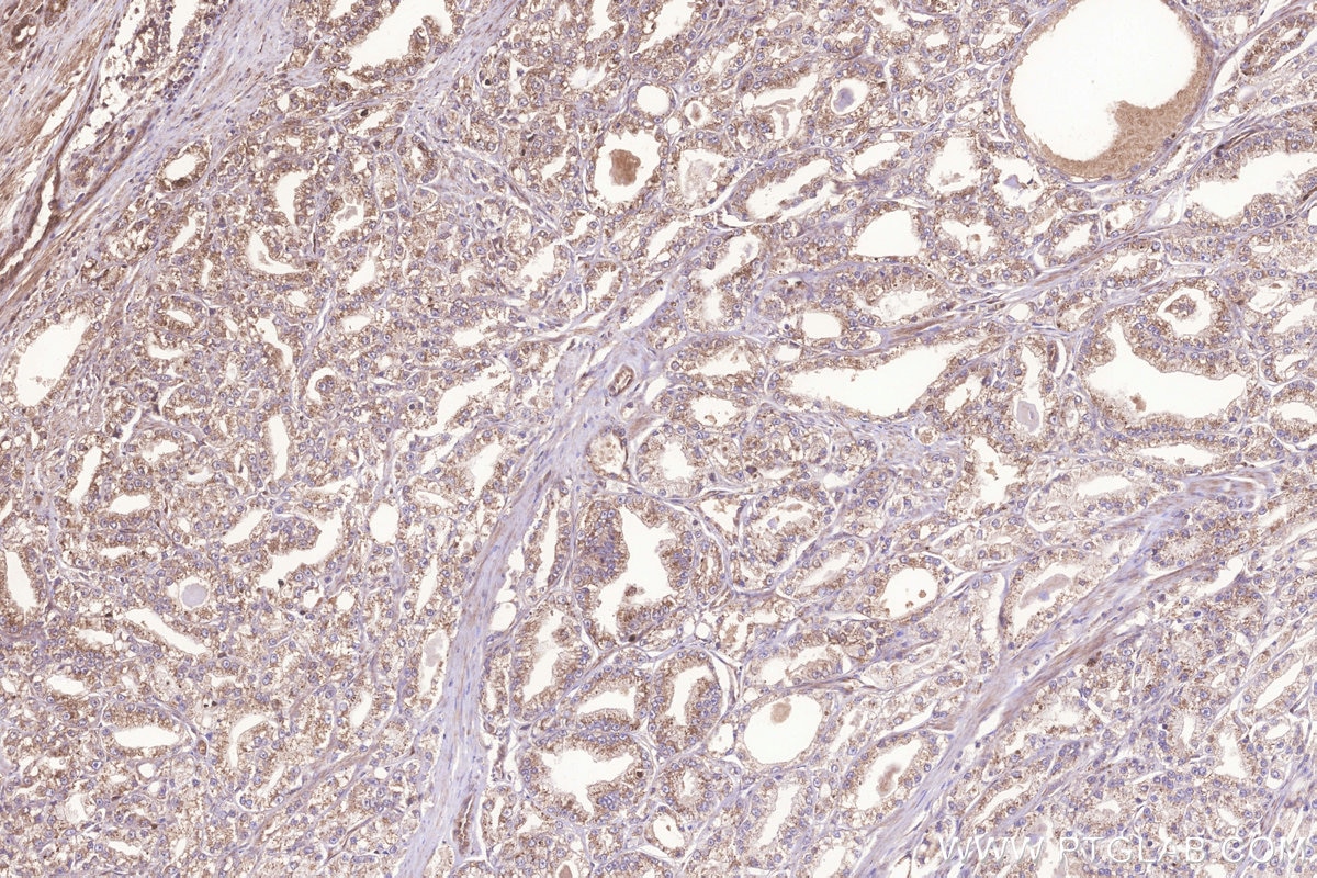 Immunohistochemistry (IHC) staining of human prostate cancer tissue using FAM46C Polyclonal antibody (25038-1-AP)