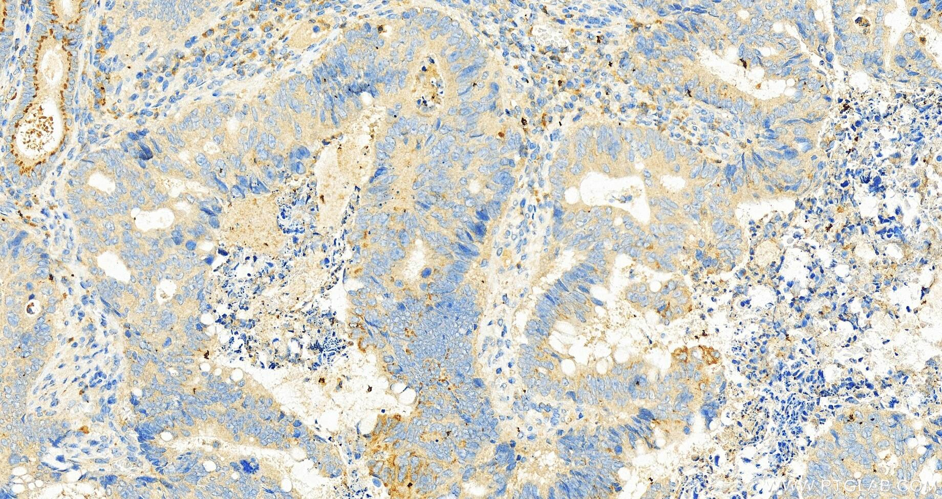 Immunohistochemistry (IHC) staining of human colon cancer tissue using FAM55A Polyclonal antibody (20996-1-AP)