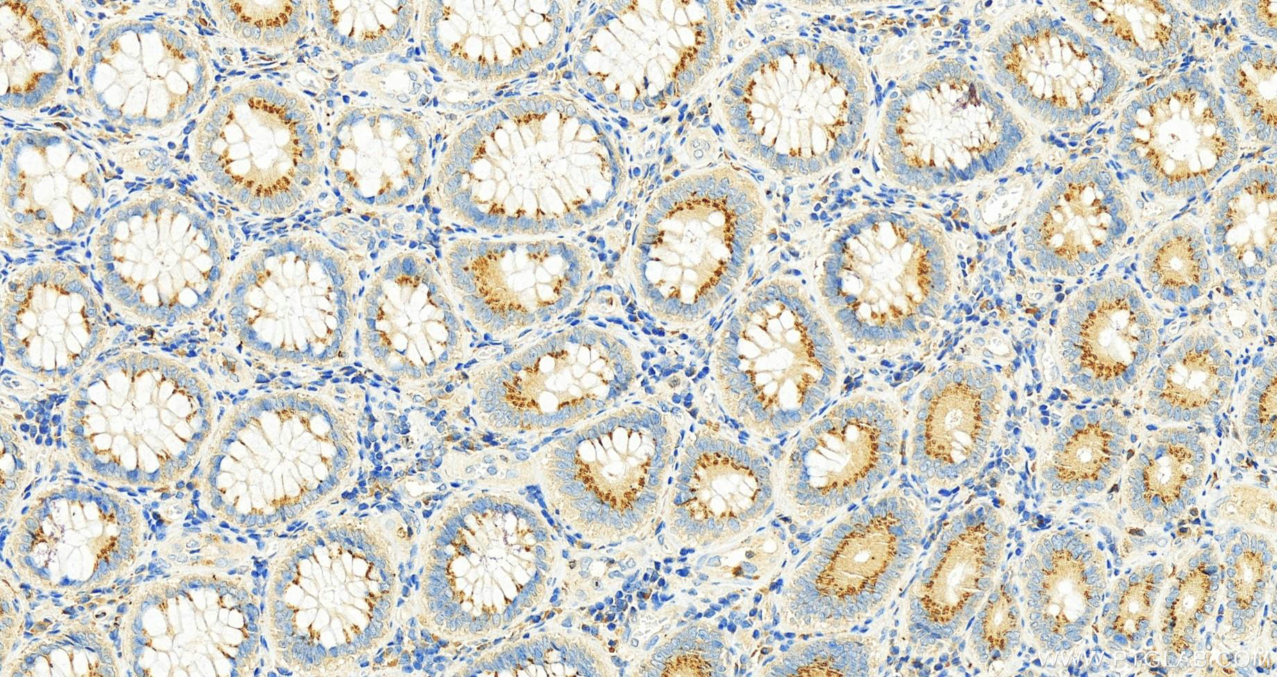Immunohistochemistry (IHC) staining of human colon cancer tissue using FAM55A Polyclonal antibody (20996-1-AP)