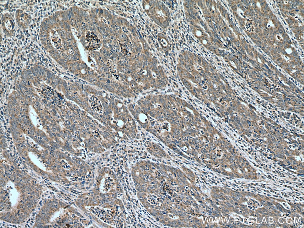 Immunohistochemistry (IHC) staining of human colon cancer tissue using FAM72 Polyclonal antibody (21203-1-AP)