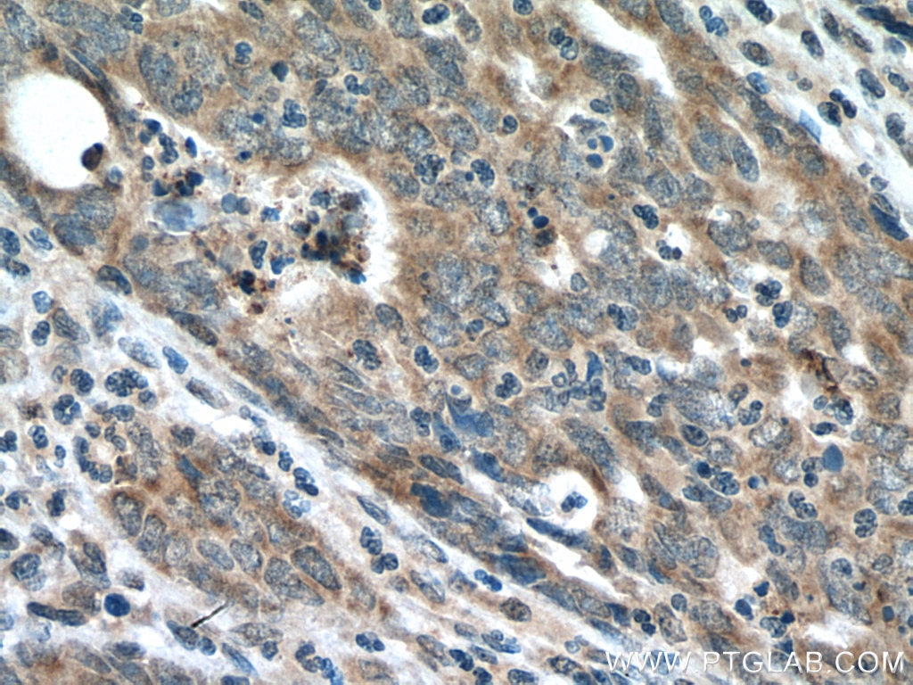 Immunohistochemistry (IHC) staining of human colon cancer tissue using FAM72 Polyclonal antibody (21203-1-AP)