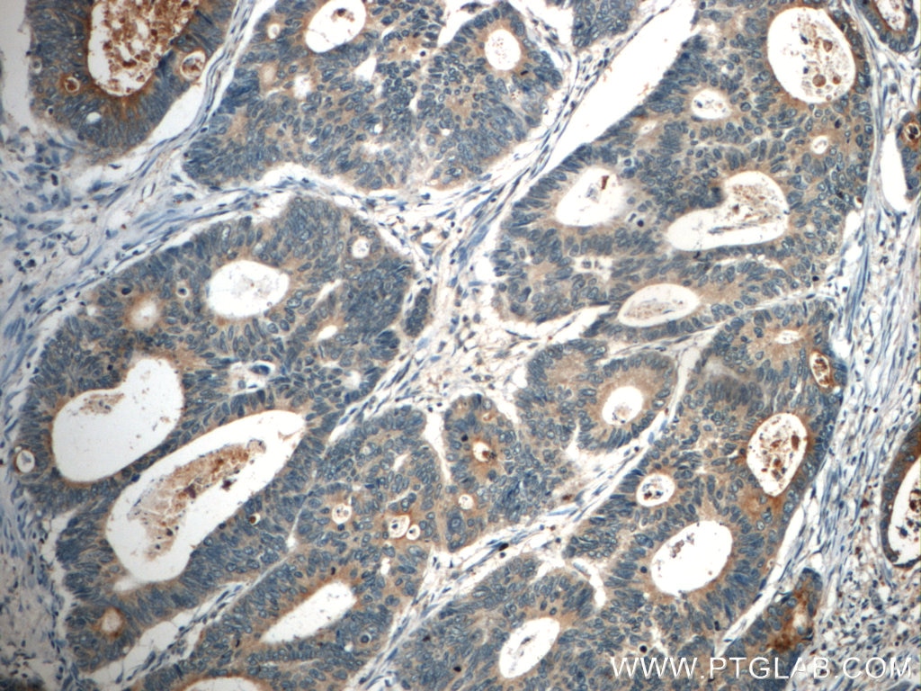 Immunohistochemistry (IHC) staining of human colon cancer tissue using FAM78A Polyclonal antibody (21038-1-AP)
