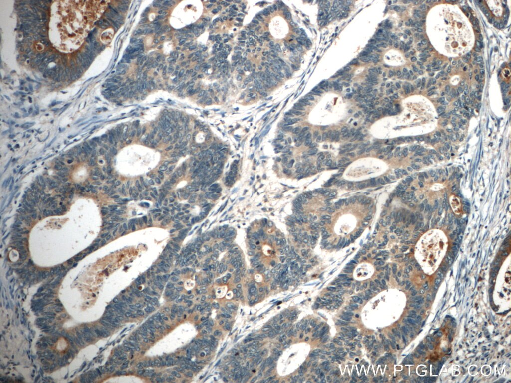 Immunohistochemistry (IHC) staining of human colon cancer tissue using FAM78A Polyclonal antibody (21038-1-AP)