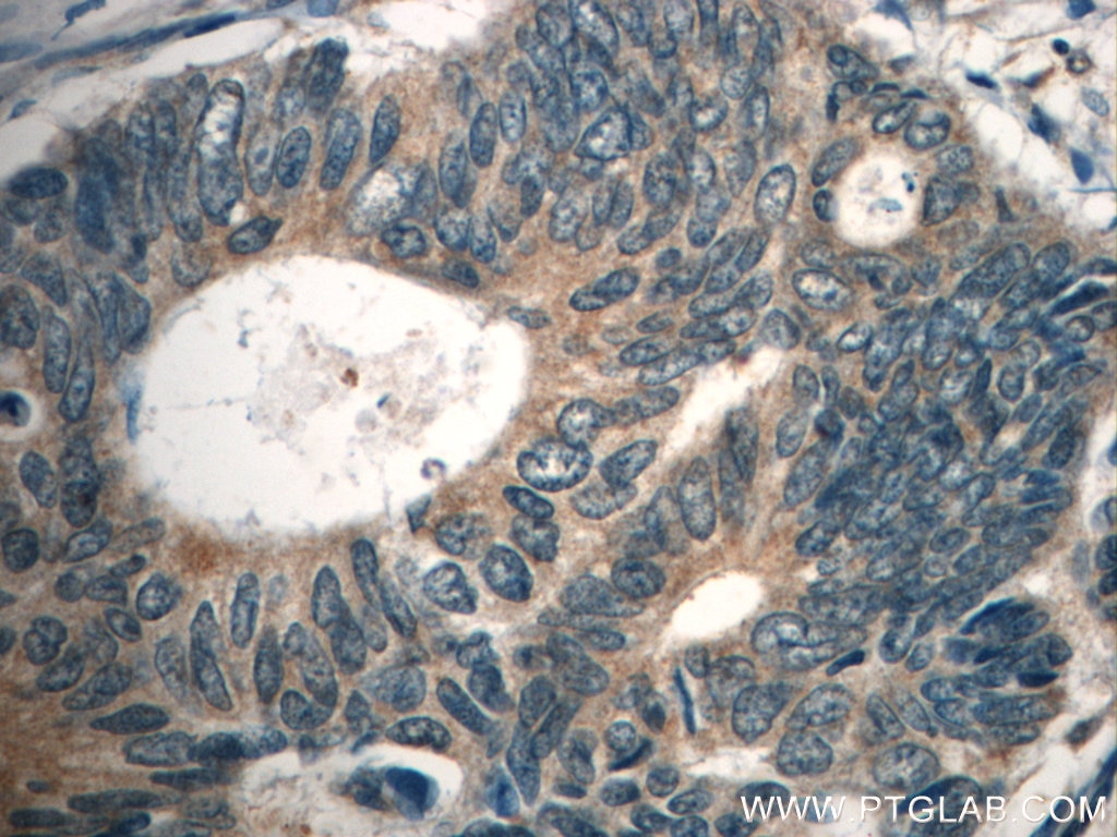 Immunohistochemistry (IHC) staining of human colon cancer tissue using FAM78A Polyclonal antibody (21038-1-AP)