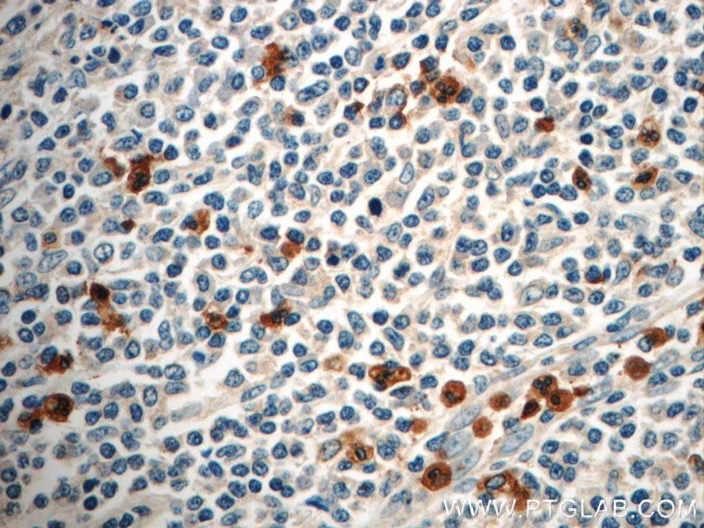 Immunohistochemistry (IHC) staining of human tonsillitis tissue using FAM78A Polyclonal antibody (21038-1-AP)