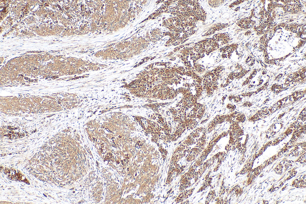 Immunohistochemical analysis of paraffin-embedded human urothelial carcinoma tissue slide using 33752-1-AP (FAM82A1 antibody) at dilution of 1:200 (under 10x lens). Heat mediated antigen retrieval with Tris-EDTA buffer (pH 9.0). Immunohistochemistry (IHC) staining of human urothelial carcinoma tissue using FAM82A1 Polyclonal antibody (33752-1-AP)