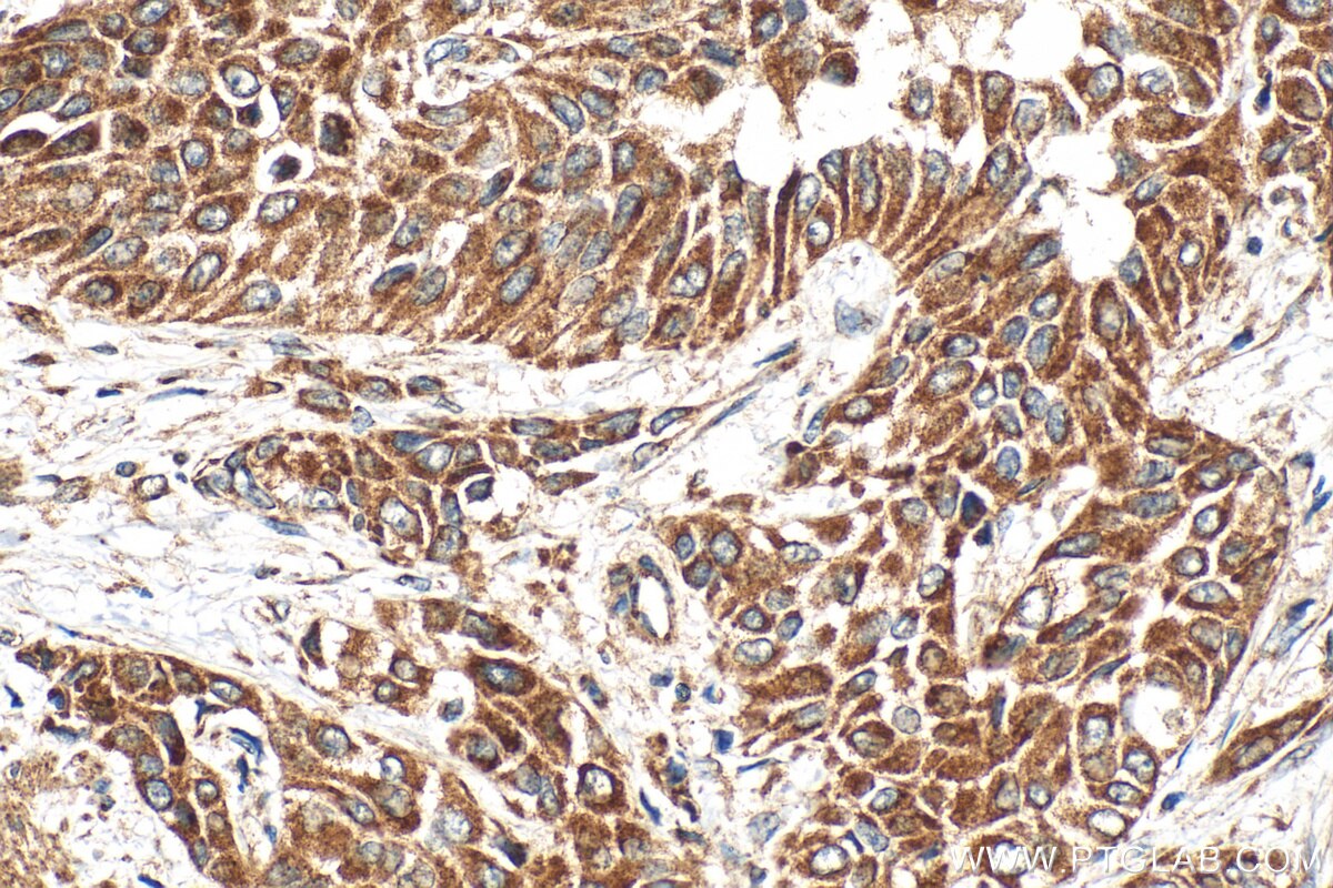 Immunohistochemical analysis of paraffin-embedded human urothelial carcinoma tissue slide using 33752-1-AP (FAM82A1 antibody) at dilution of 1:200 (under 40x lens). Heat mediated antigen retrieval with Tris-EDTA buffer (pH 9.0). Immunohistochemistry (IHC) staining of human urothelial carcinoma tissue using FAM82A1 Polyclonal antibody (33752-1-AP)