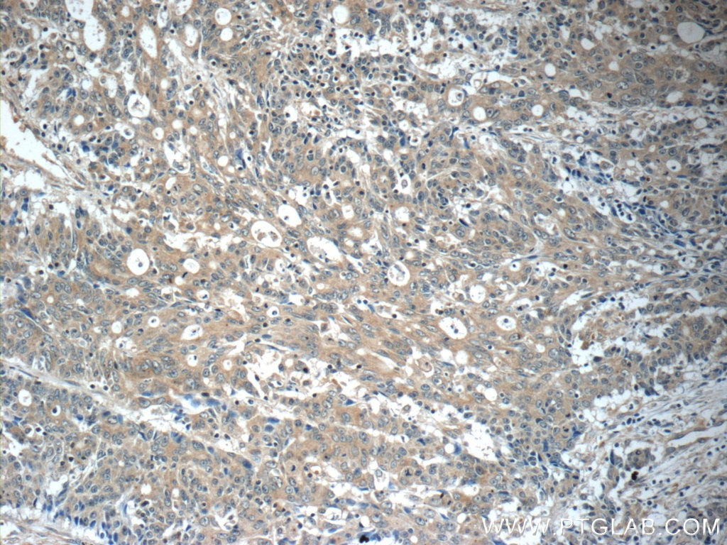Immunohistochemistry (IHC) staining of human colon cancer tissue using FAM83A Polyclonal antibody (20618-1-AP)