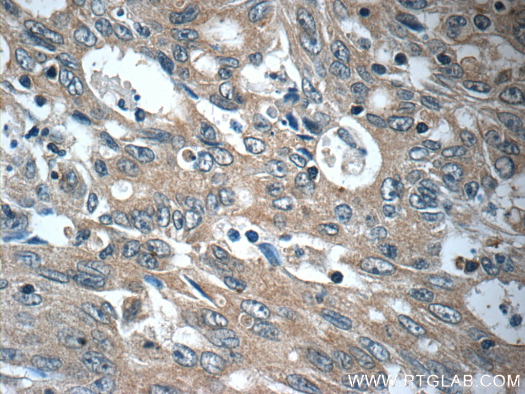 Immunohistochemistry (IHC) staining of human colon cancer tissue using FAM83A Polyclonal antibody (20618-1-AP)