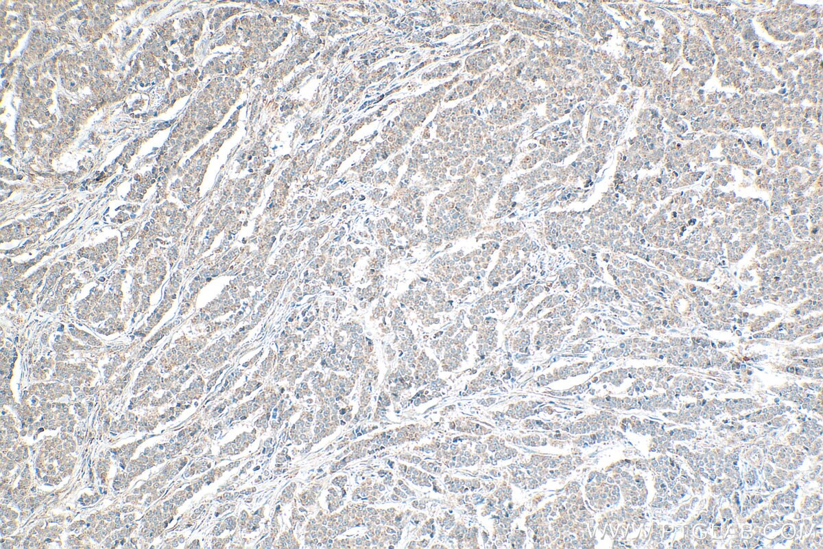 Immunohistochemistry (IHC) staining of human colon cancer tissue using FAM83A Polyclonal antibody (29289-1-AP)