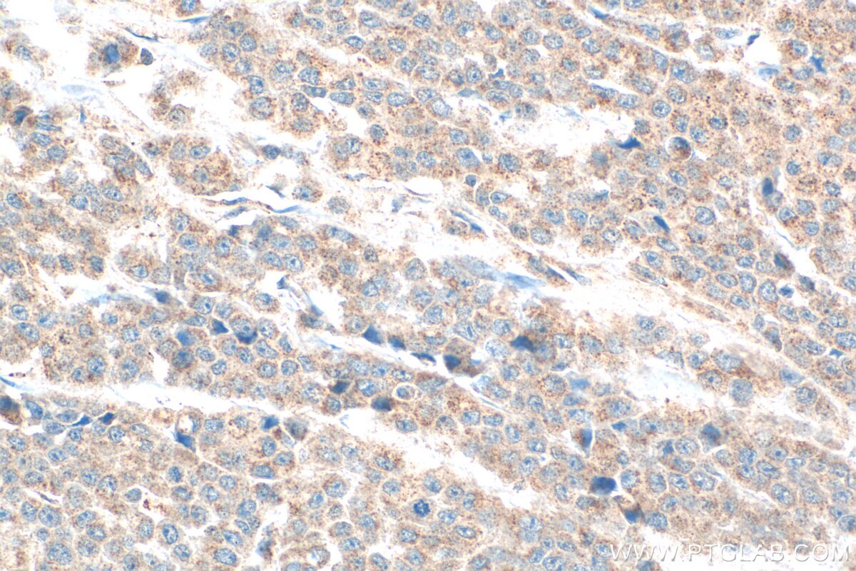 Immunohistochemistry (IHC) staining of human colon cancer tissue using FAM83A Polyclonal antibody (29289-1-AP)