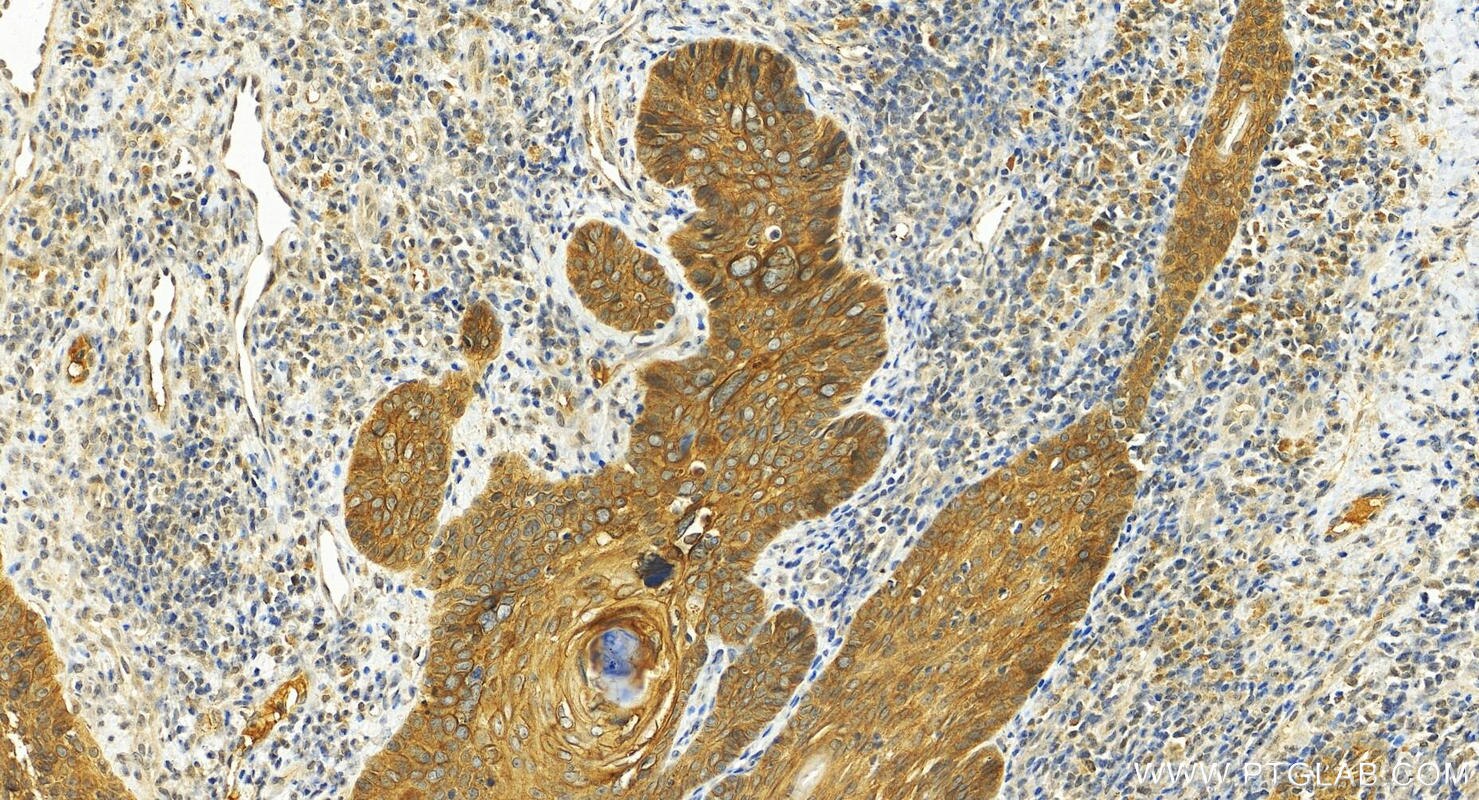 Immunohistochemistry (IHC) staining of human brown disease using FAM83B Polyclonal antibody (26032-1-AP)