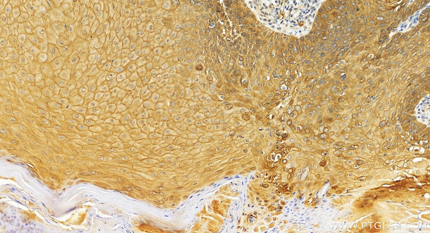 Immunohistochemistry (IHC) staining of human brown disease using FAM83B Polyclonal antibody (26032-1-AP)
