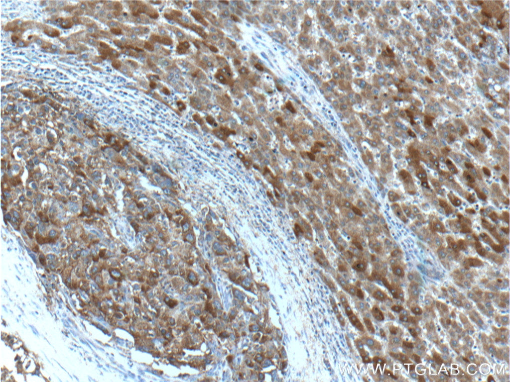Immunohistochemistry (IHC) staining of human liver cancer tissue using FAM84B Polyclonal antibody (18421-1-AP)