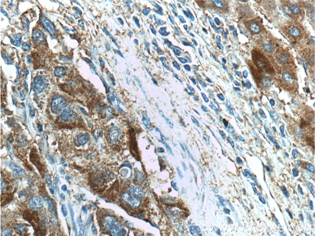 Immunohistochemistry (IHC) staining of human liver cancer tissue using FAM84B Polyclonal antibody (18421-1-AP)