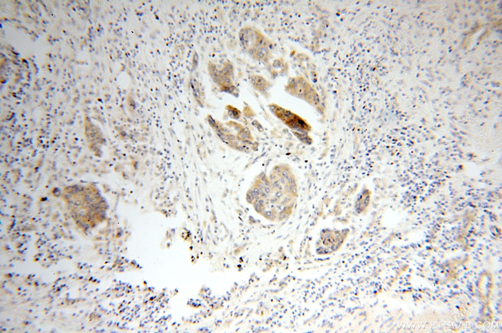 Immunohistochemistry (IHC) staining of human oesophagus cancer tissue using FAM84B Polyclonal antibody (18421-1-AP)