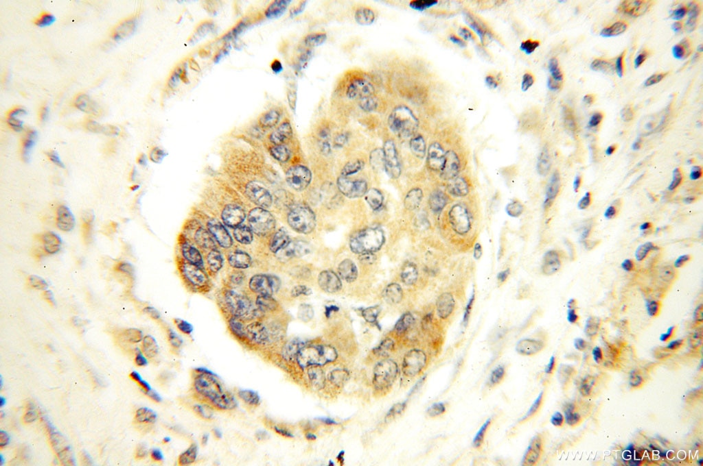 Immunohistochemistry (IHC) staining of human oesophagus cancer tissue using FAM84B Polyclonal antibody (18421-1-AP)