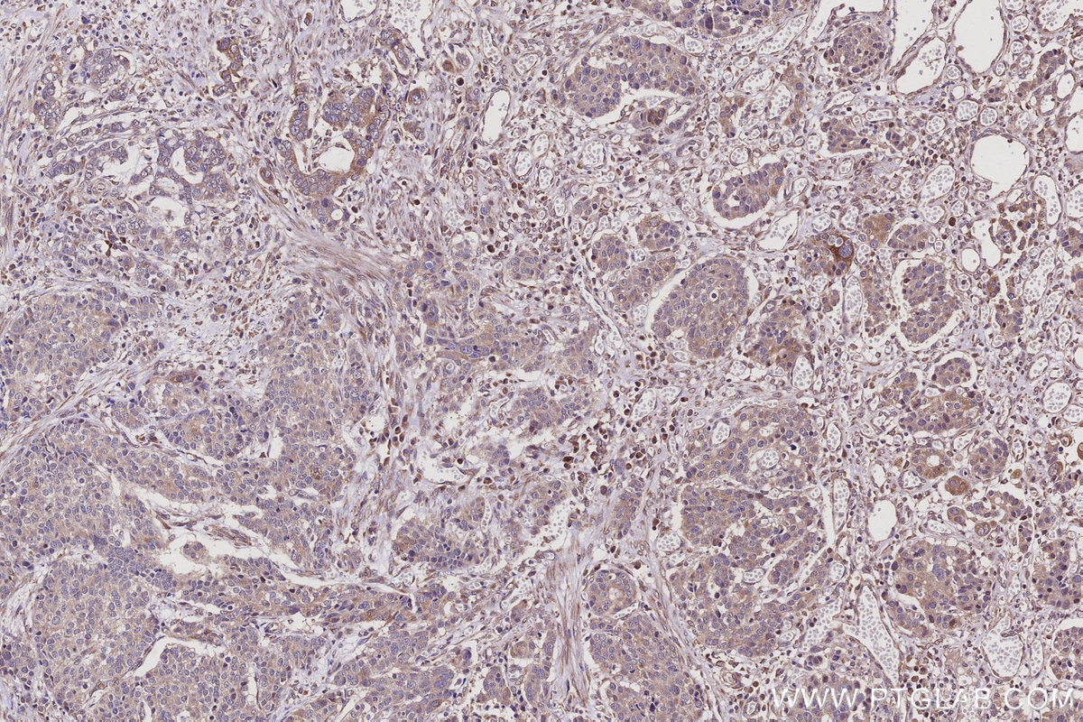 Immunohistochemistry (IHC) staining of human stomach cancer tissue using FAM8A1 Polyclonal antibody (24746-1-AP)