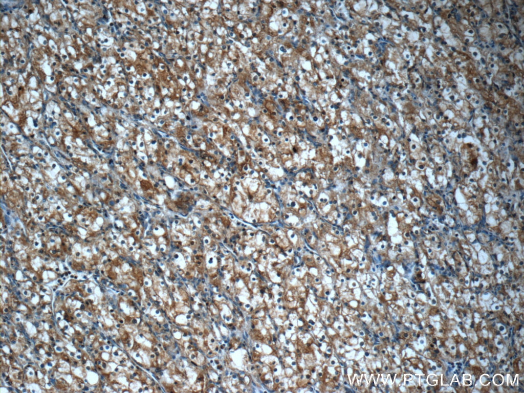 Immunohistochemistry (IHC) staining of human renal cell carcinoma tissue using FAM92A1 Polyclonal antibody (24803-1-AP)