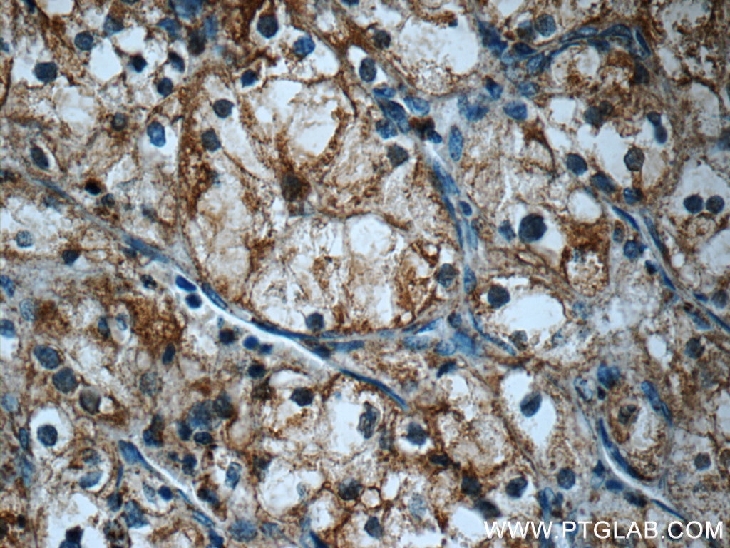 Immunohistochemistry (IHC) staining of human renal cell carcinoma tissue using FAM92A1 Polyclonal antibody (24803-1-AP)