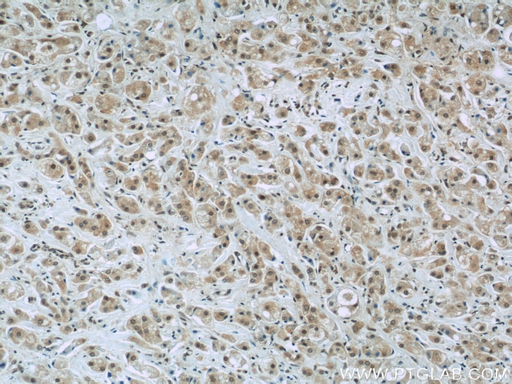 Immunohistochemistry (IHC) staining of human breast cancer tissue using FAM98B Polyclonal antibody (22251-1-AP)
