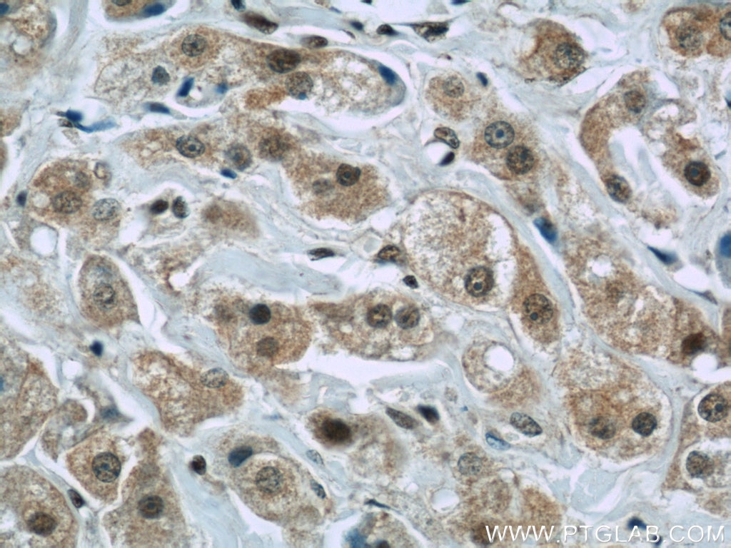 Immunohistochemistry (IHC) staining of human breast cancer tissue using FAM98B Polyclonal antibody (22251-1-AP)