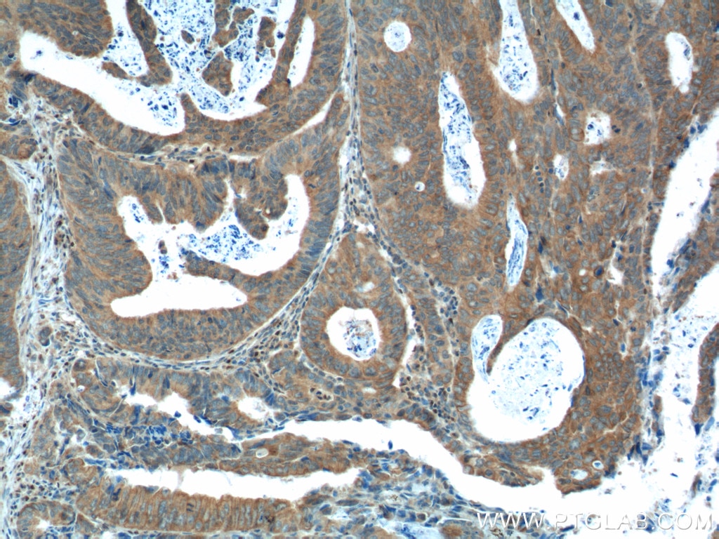 Immunohistochemistry (IHC) staining of human colon cancer tissue using FANCA Polyclonal antibody (11975-1-AP)