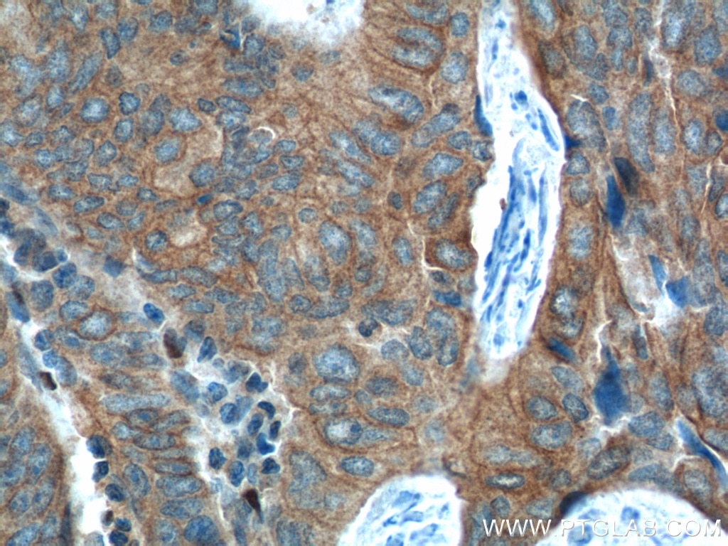 Immunohistochemistry (IHC) staining of human colon cancer tissue using FANCA Polyclonal antibody (11975-1-AP)