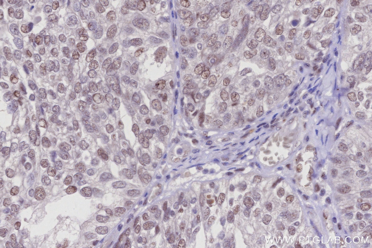 IHC staining of human ovary cancer using 20789-1-AP Immunohistochemistry (IHC) staining of human ovary cancer tissue using FANCI Polyclonal antibody (20789-1-AP)
