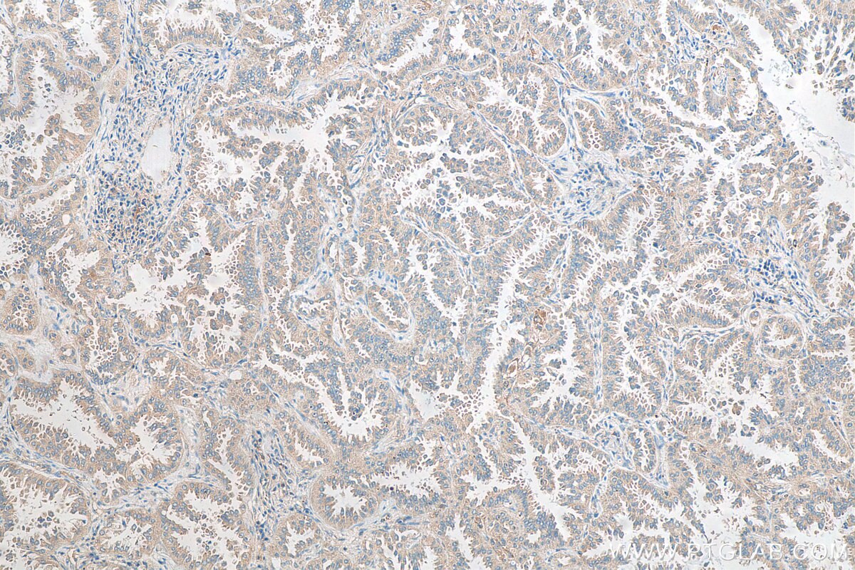 IHC staining of human lung cancer using 14454-1-AP
