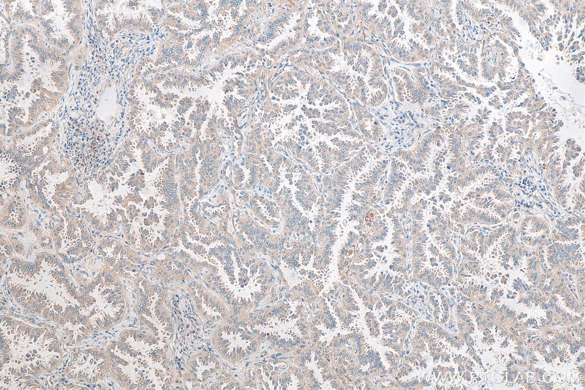 Immunohistochemistry (IHC) staining of human lung cancer tissue using FANCL Polyclonal antibody (14454-1-AP)