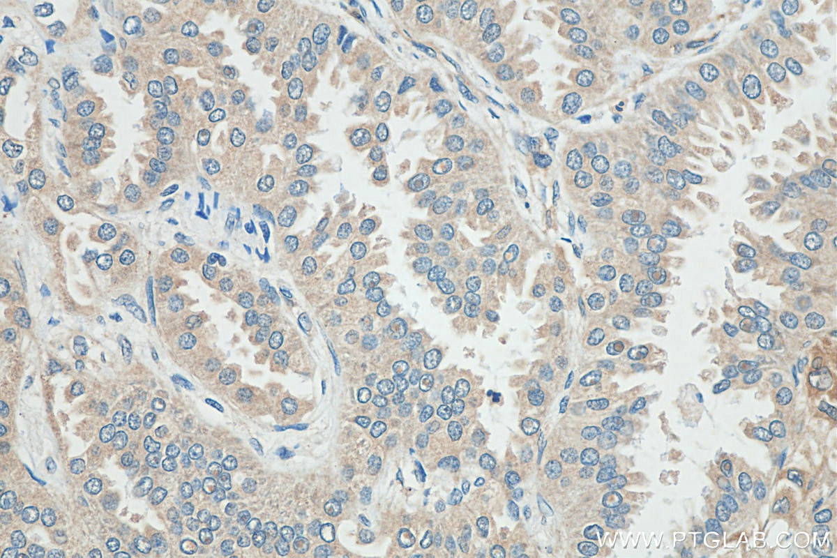 Immunohistochemistry (IHC) staining of human lung cancer tissue using FANCL Polyclonal antibody (14454-1-AP)