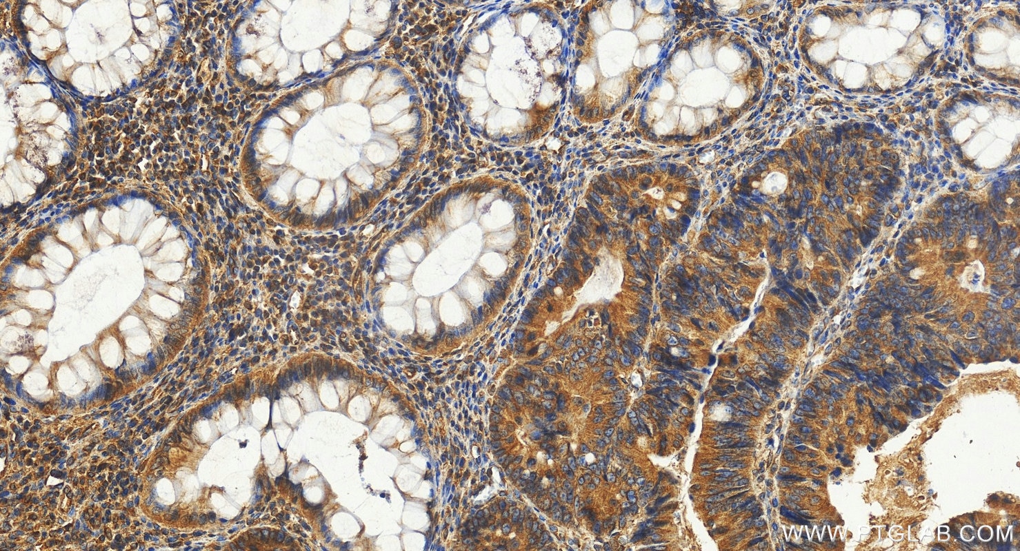 Immunohistochemistry (IHC) staining of human colon cancer tissue using FAR2 Polyclonal antibody (27717-1-AP)