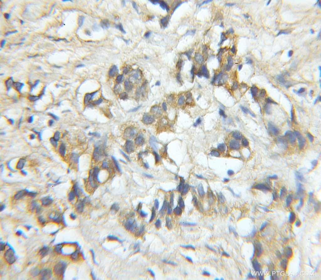 Immunohistochemistry (IHC) staining of human prostate cancer tissue using FARP2 Polyclonal antibody (11488-1-AP)