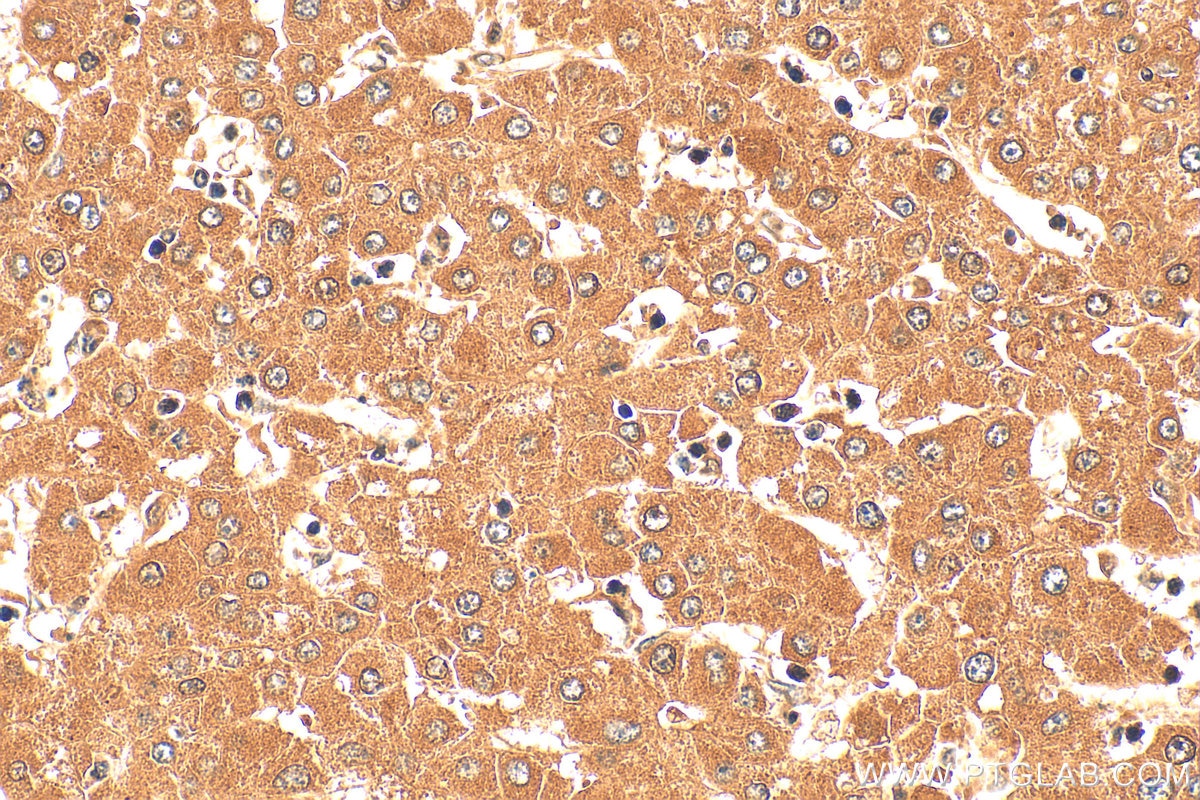 Immunohistochemistry (IHC) staining of human liver cancer tissue using FARS2 Polyclonal antibody (16436-1-AP)
