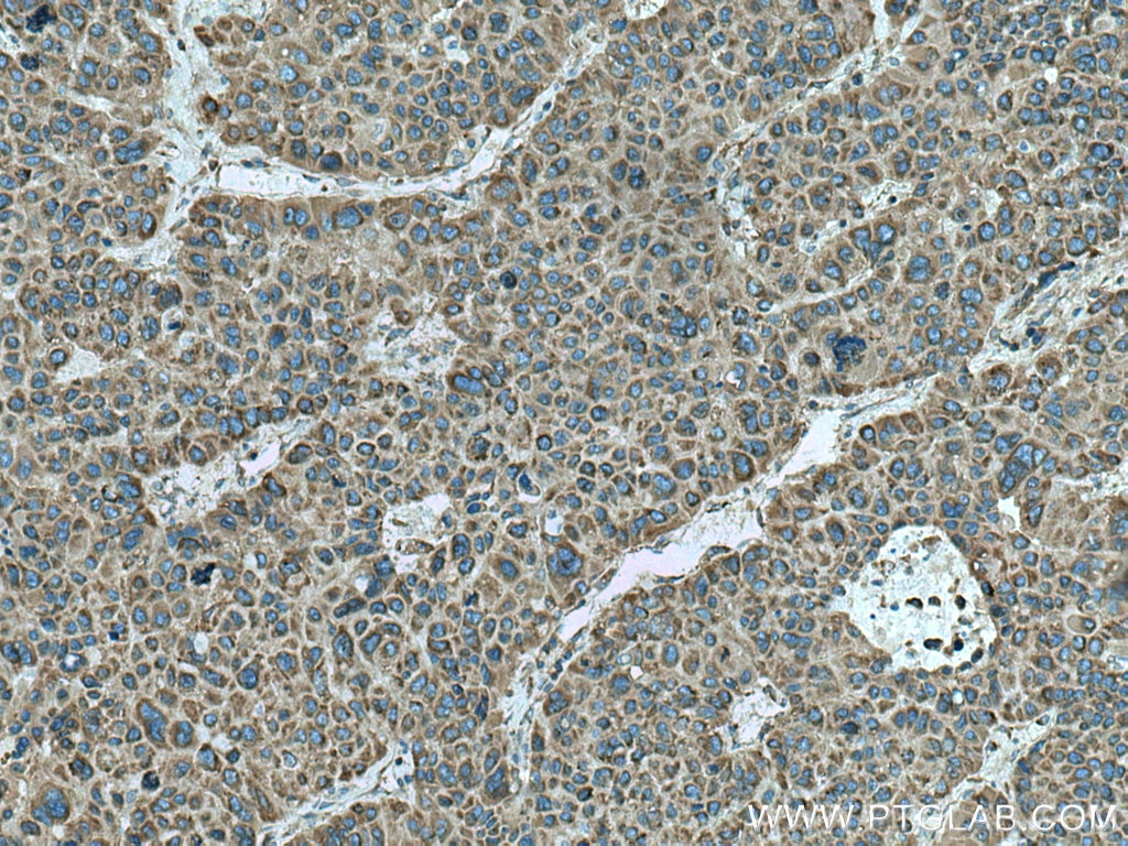 Immunohistochemistry (IHC) staining of human liver cancer tissue using FARSA Polyclonal antibody (18121-1-AP)