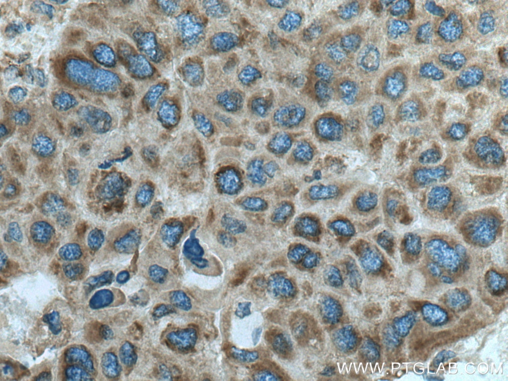 Immunohistochemistry (IHC) staining of human liver cancer tissue using FARSA Polyclonal antibody (18121-1-AP)