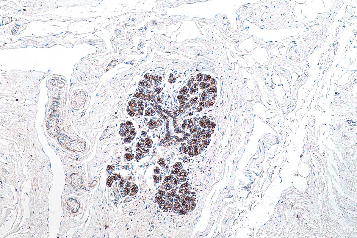 Immunohistochemistry (IHC) staining of human breast cancer tissue using FARSA Monoclonal antibody (67945-1-Ig)
