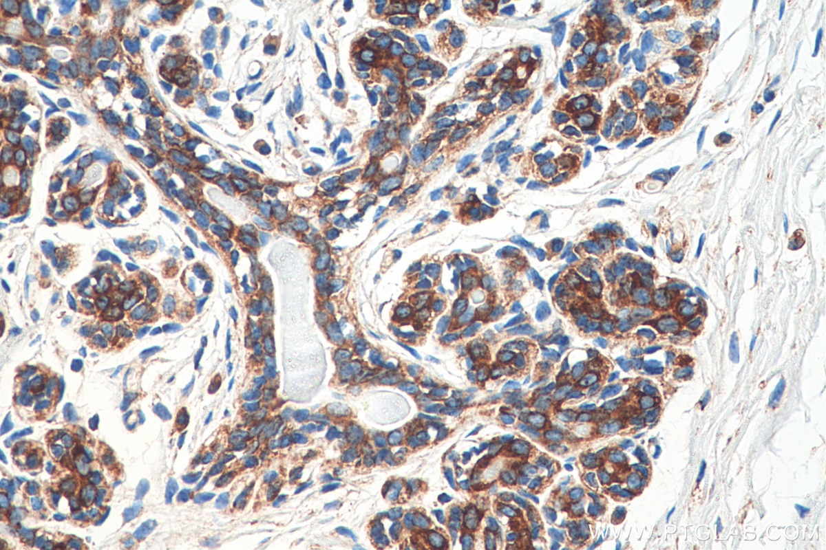 Immunohistochemistry (IHC) staining of human breast cancer tissue using FARSA Monoclonal antibody (67945-1-Ig)