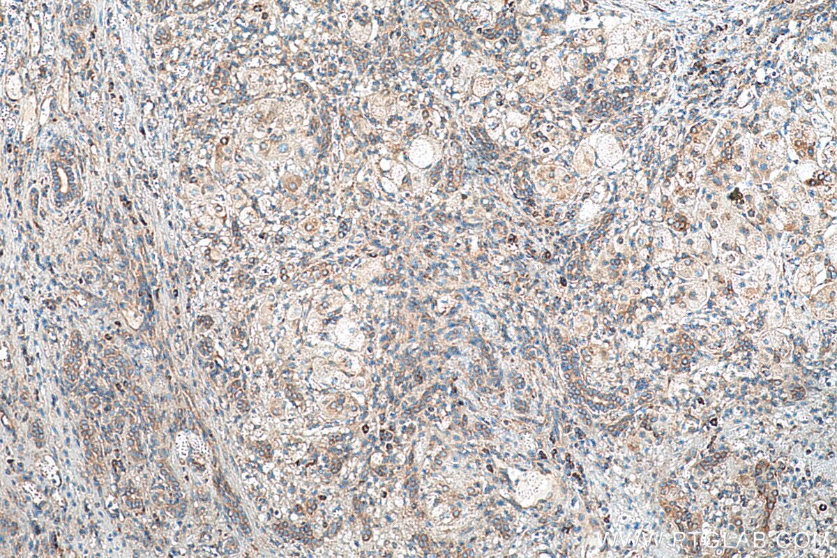 Immunohistochemistry (IHC) staining of human liver cancer tissue using FARSA Monoclonal antibody (67945-1-Ig)
