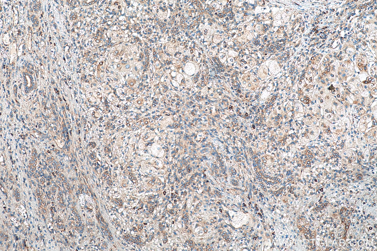 Immunohistochemistry (IHC) staining of human liver cancer tissue using FARSA Monoclonal antibody (67945-1-Ig)