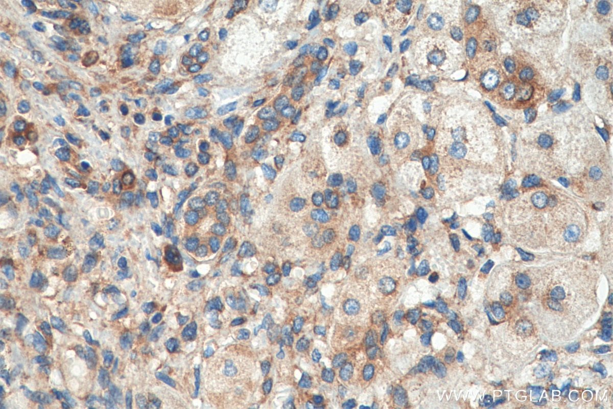 IHC staining of human liver cancer using 67945-1-Ig
